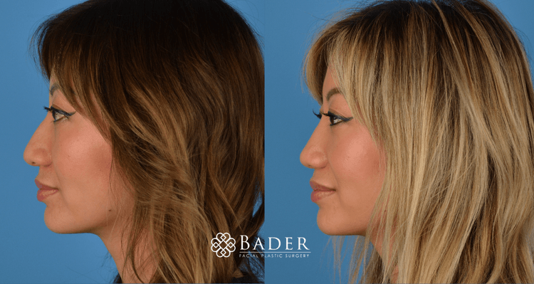 Bader Rhinoplasty Primary Rhinoplasty Before & After Photos | Bader Facial Plastics