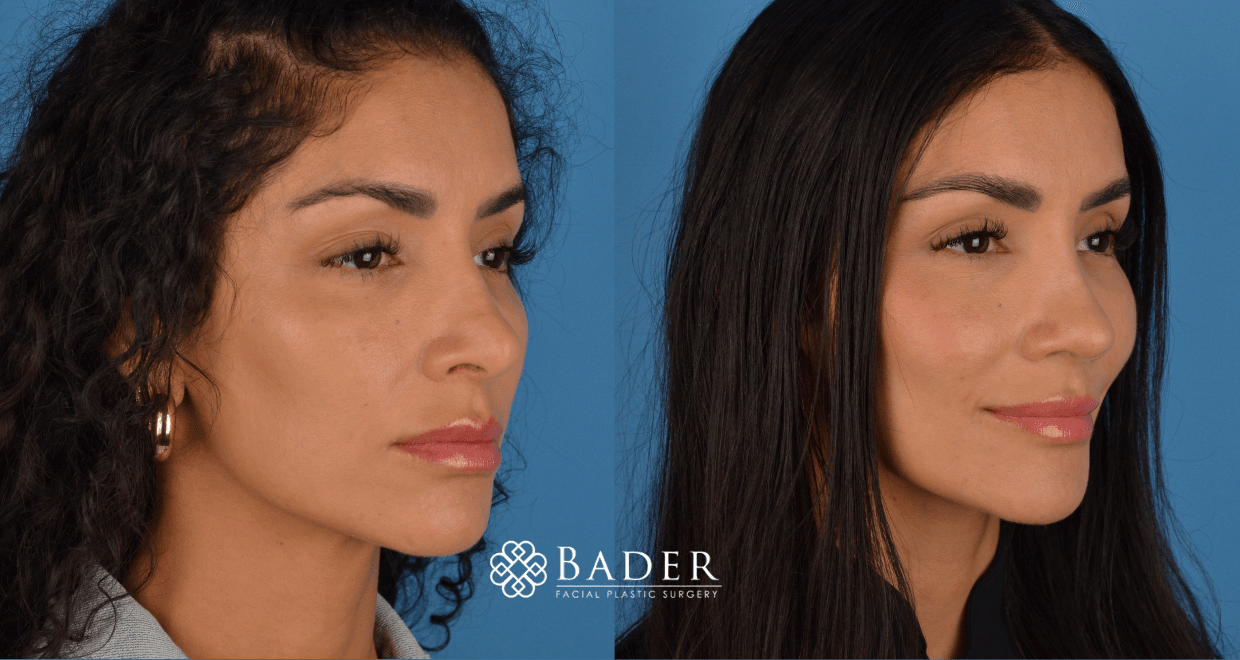 Bader Rhinoplasty Revision Rhinoplasty - Patient 5