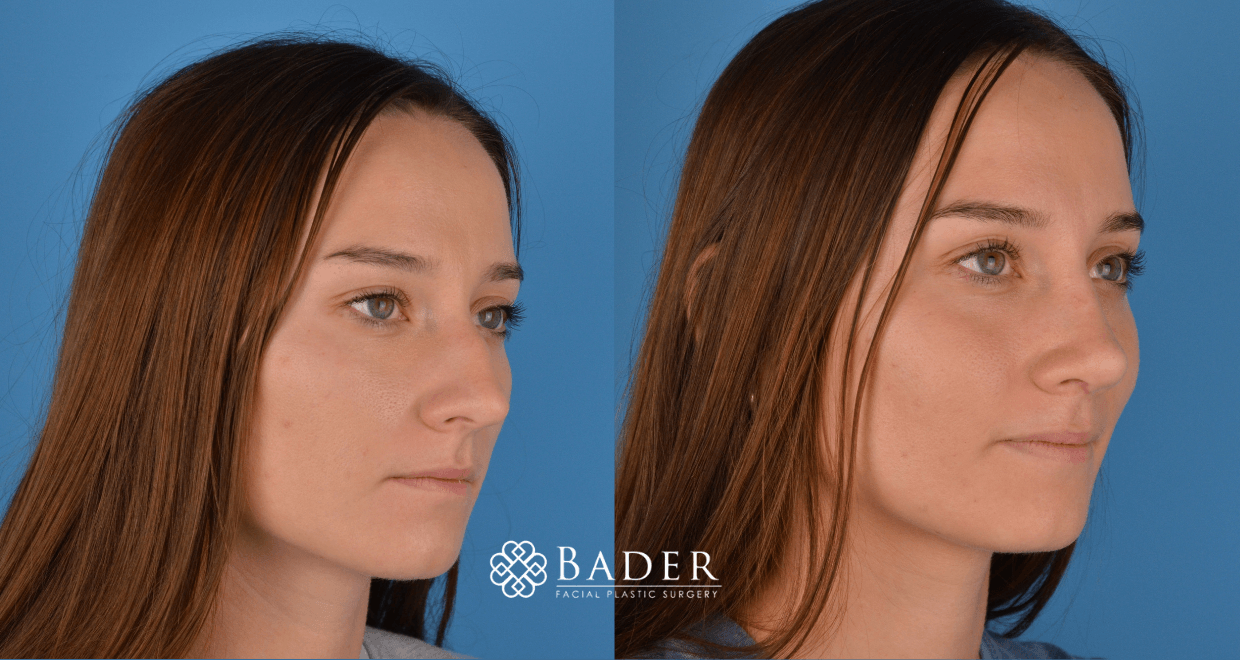 Bader Rhinoplasty Primary Rhinoplasty - Patient 54