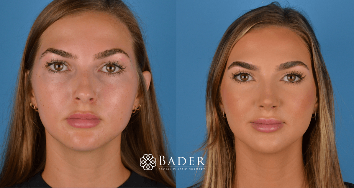 Bader Rhinoplasty Primary Rhinoplasty Before & After Photos | Bader Facial Plastics