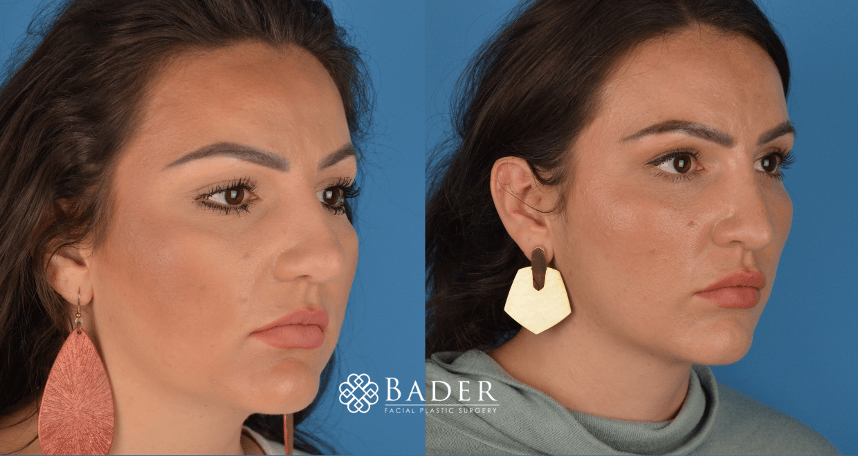 Bader Rhinoplasty Primary Rhinoplasty - Patient 44