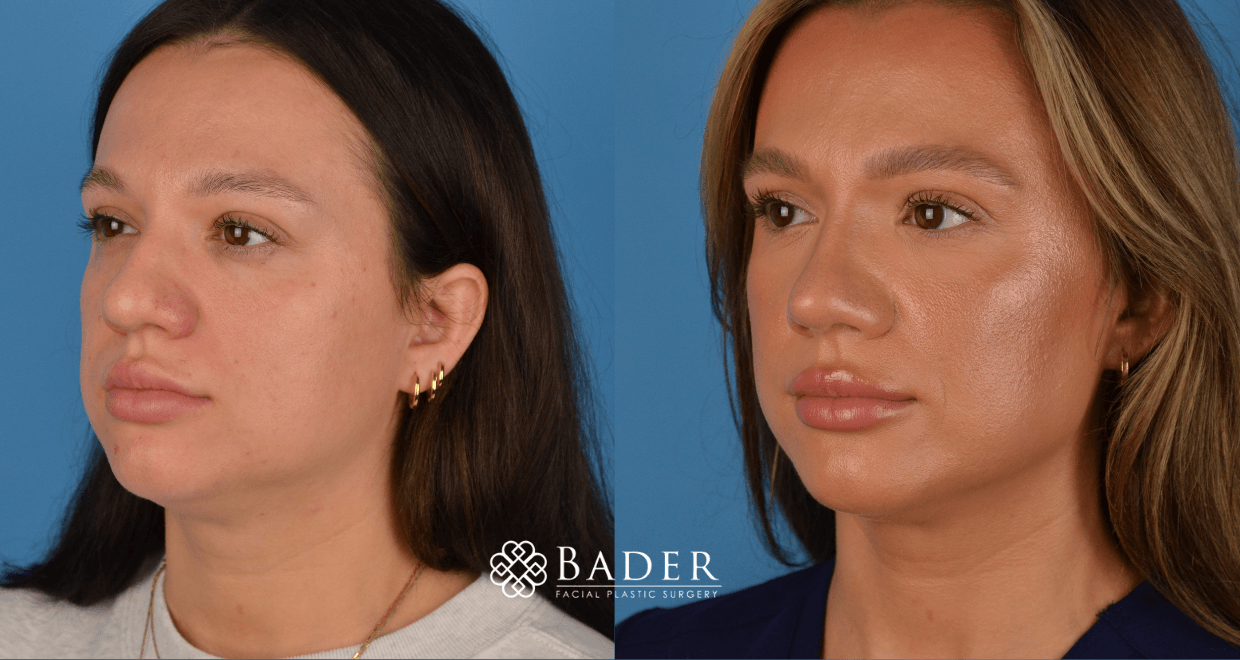 Bader Rhinoplasty Primary Rhinoplasty - Patient 27