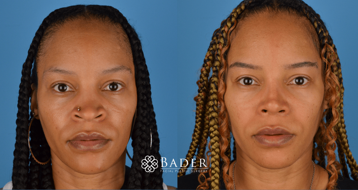 Bader Rhinoplasty Primary Rhinoplasty Before & After Photos | Bader Facial Plastics