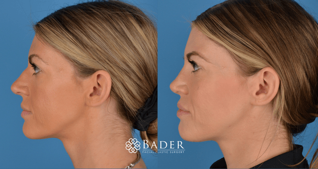 Bader Rhinoplasty Primary Rhinoplasty - Patient 2