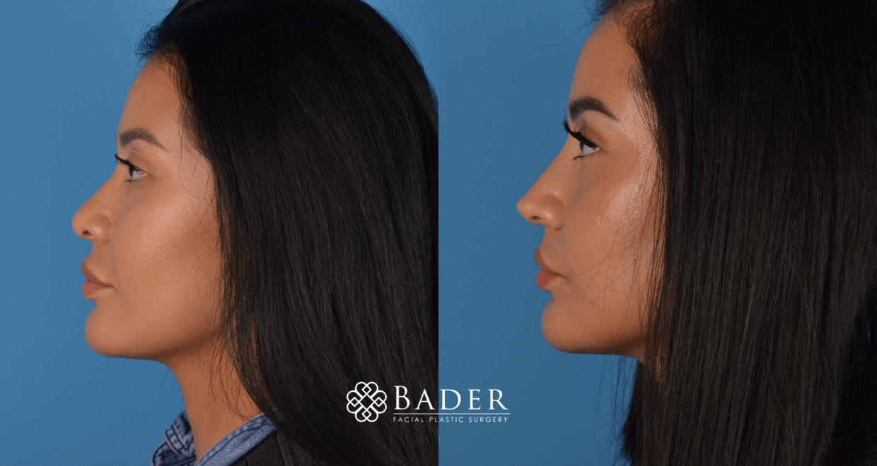 Bader Rhinoplasty Primary Rhinoplasty - Patient 12