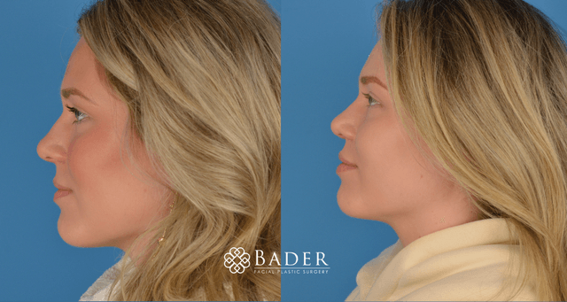 Bader Rhinoplasty Primary Rhinoplasty - Patient 2