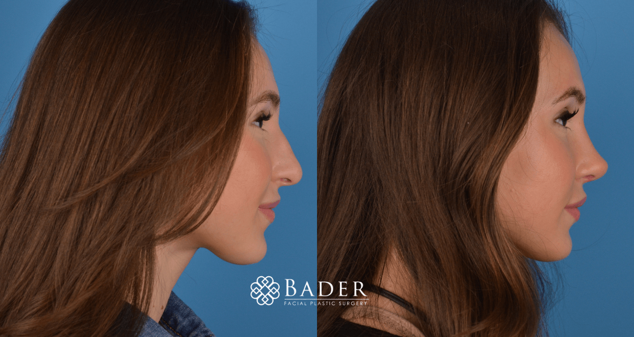Bader Rhinoplasty Primary Rhinoplasty - Patient 1