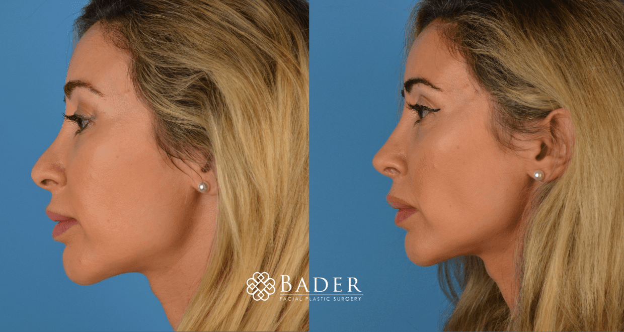 Bader Rhinoplasty Revision Rhinoplasty - Patient 1