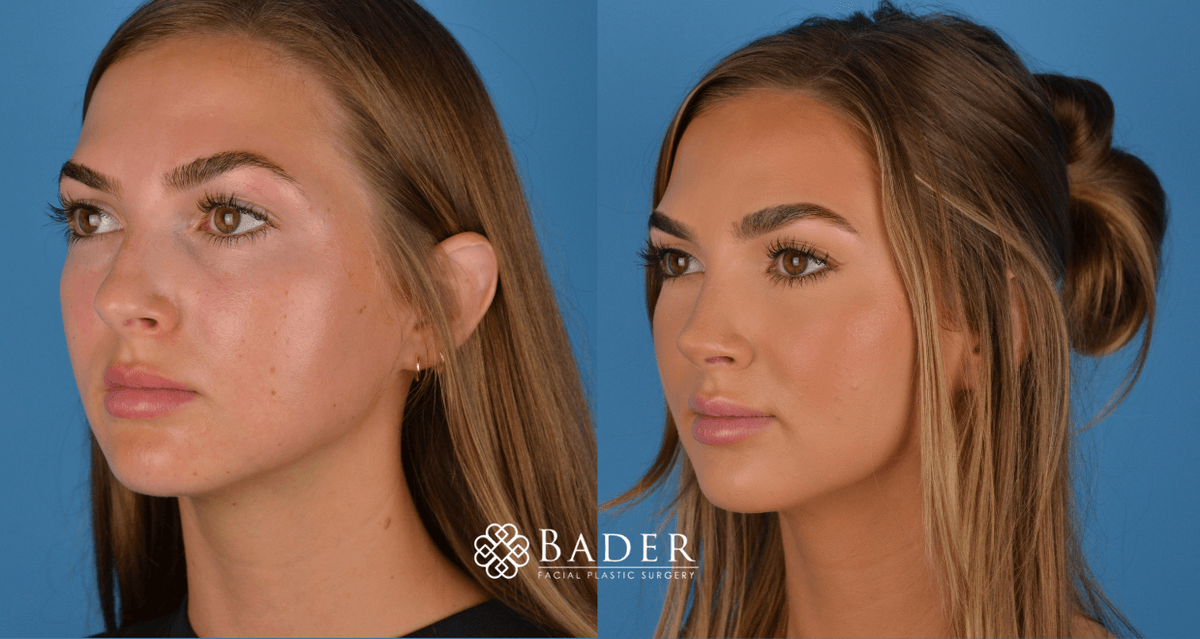 Bader Rhinoplasty Primary Rhinoplasty Before & After Photos | Bader Facial Plastics