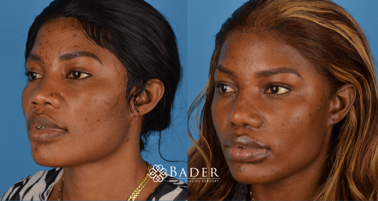 Bader Rhinoplasty Primary Rhinoplasty Before & After Photos | Bader Facial Plastics
