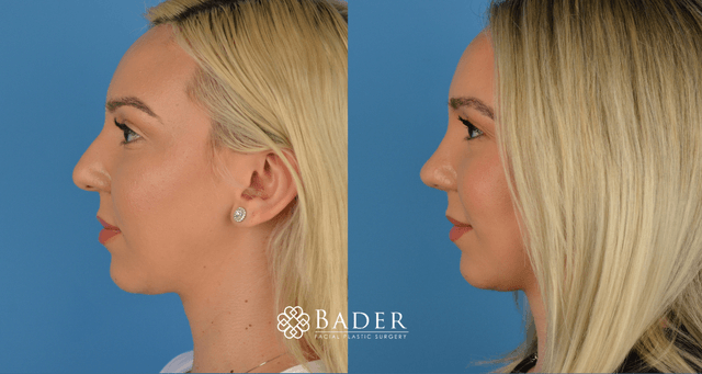 Bader Rhinoplasty Primary Rhinoplasty - Patient 2