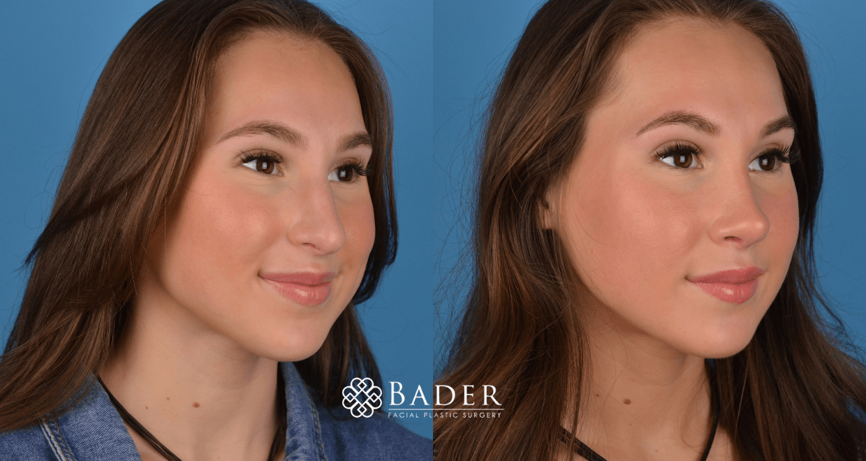 Bader Rhinoplasty Primary Rhinoplasty - Patient 1