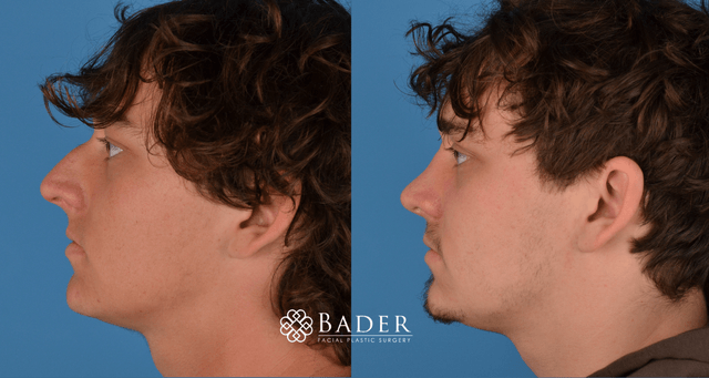 Bader Rhinoplasty Primary Rhinoplasty - Patient 2