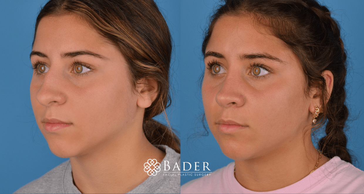 Bader Rhinoplasty Primary Rhinoplasty - Patient 45