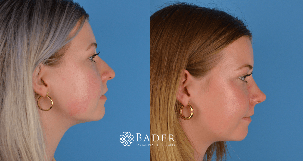 Bader Rhinoplasty Primary Rhinoplasty - Patient 18