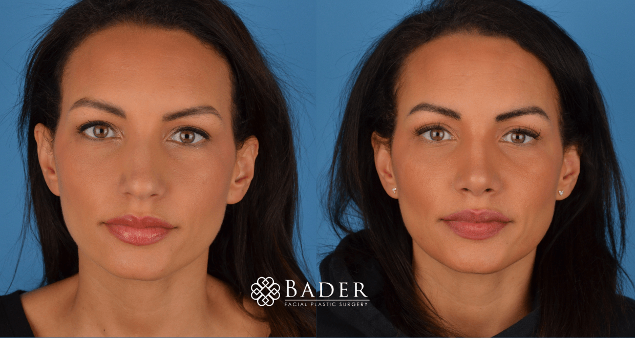 Bader Rhinoplasty Primary Rhinoplasty - Patient 3