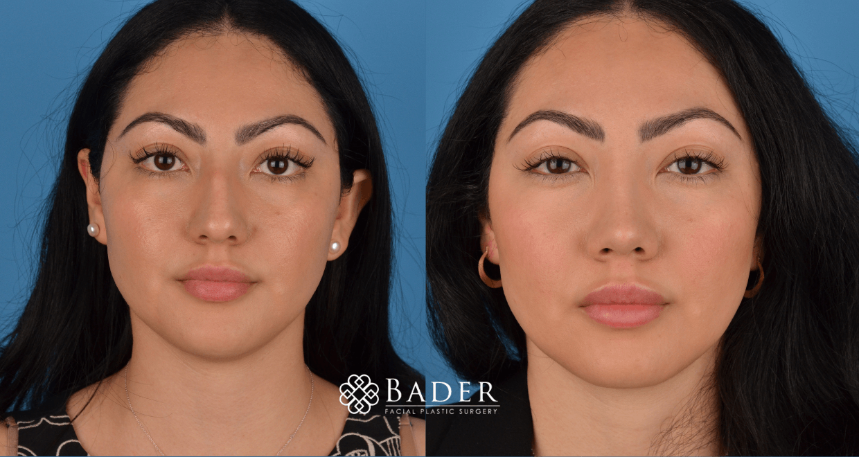 Bader Rhinoplasty Primary Rhinoplasty - Patient 20