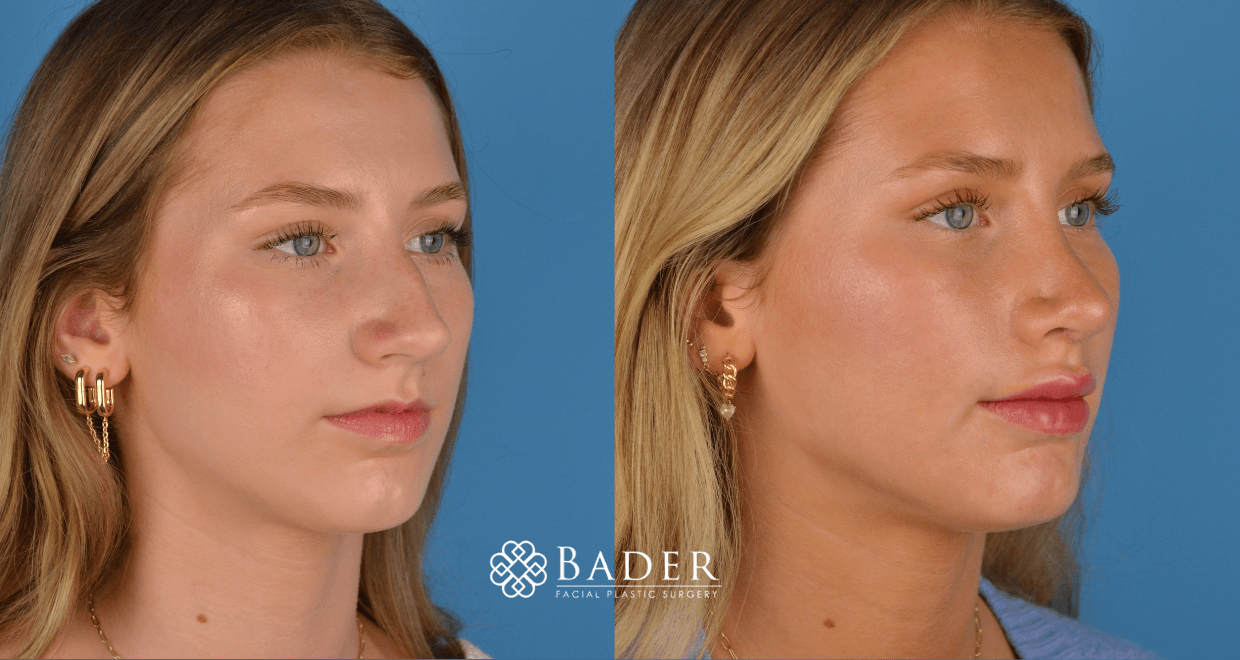 Bader Rhinoplasty Primary Rhinoplasty - Patient 41