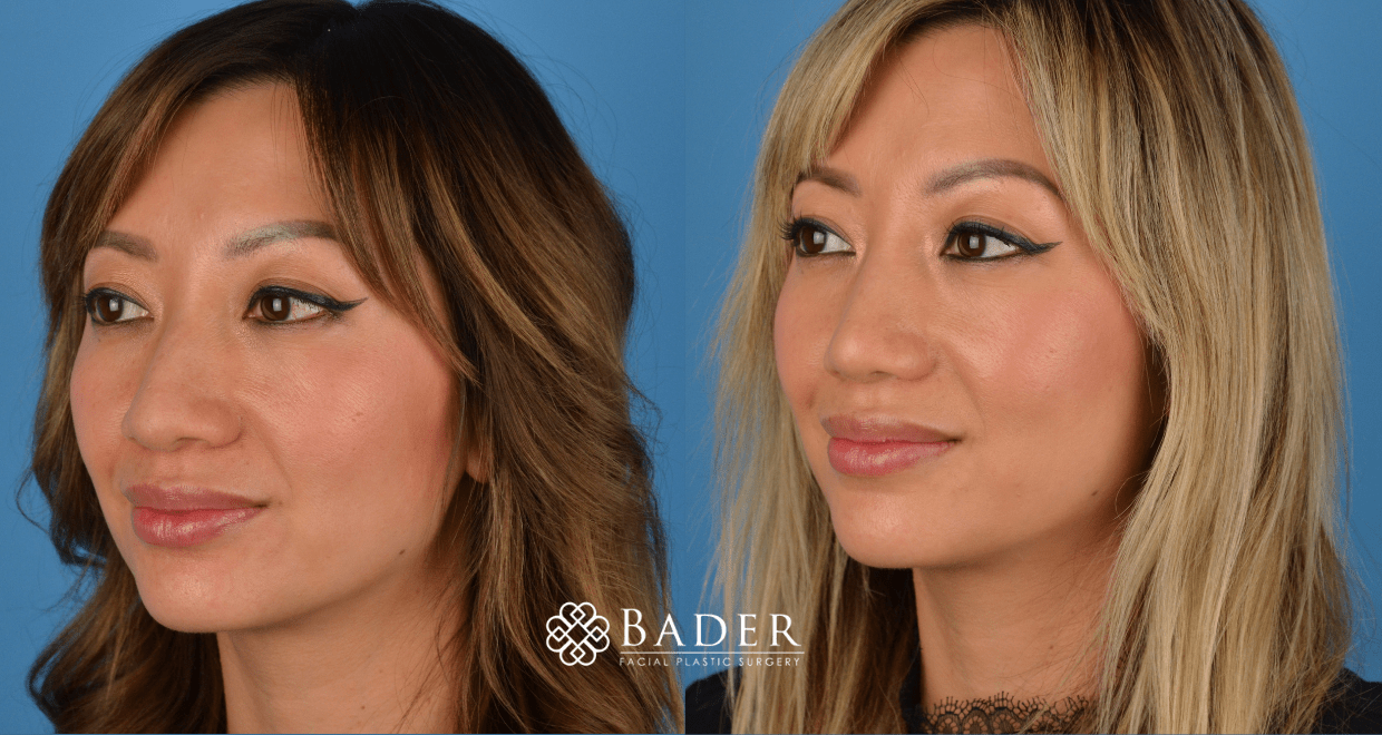 Bader Rhinoplasty Primary Rhinoplasty Before & After Photos | Bader Facial Plastics